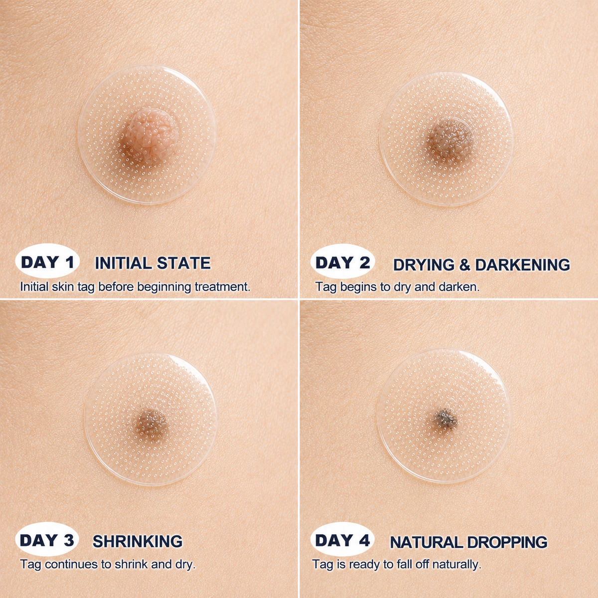 🌿Botanical Microneedle Hydrocolloid Patches — Targeted At-Home Skincare for Small Areas of Concern | For Moles, Acne, Flat Warts, Skin Tags, Wrinkles, Scars & Blemishes| Devareon®