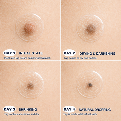 🌿Botanical Microneedle Hydrocolloid Patches — Targeted At-Home Skincare for Small Areas of Concern | For Moles, Acne, Flat Warts, Skin Tags, Wrinkles, Scars & Blemishes| Devareon®